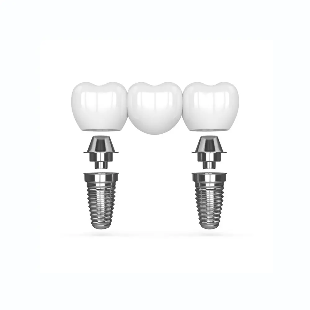 dental implant bridge model