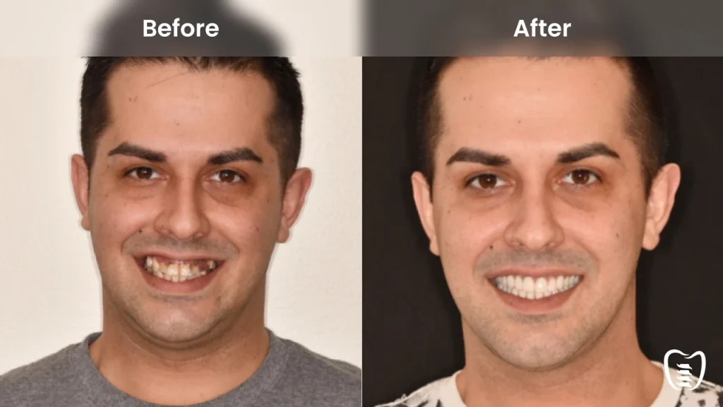 Before and after dental implants at All On Implants Charleston