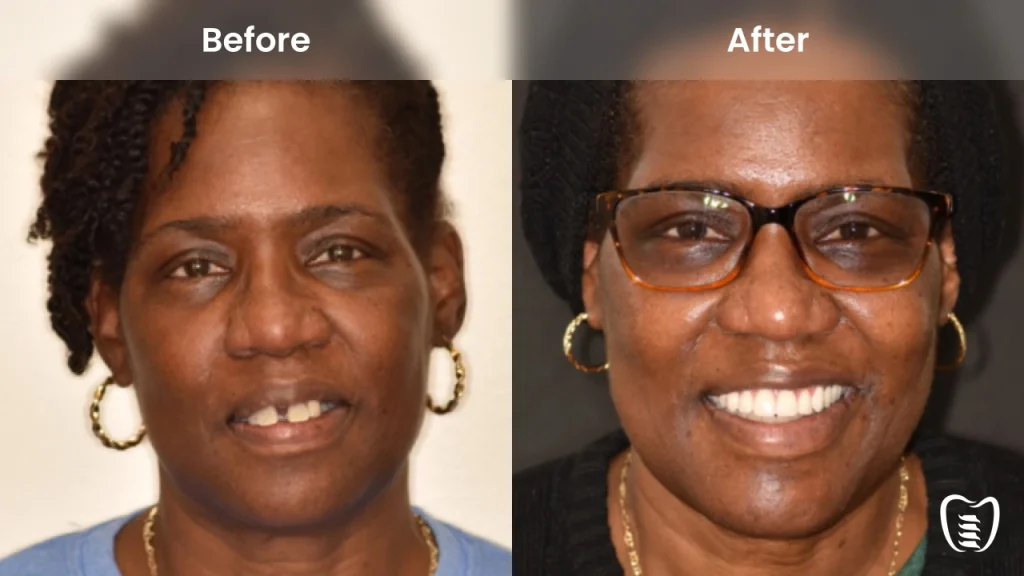 Before and after dental implants at All On Implants Charleston