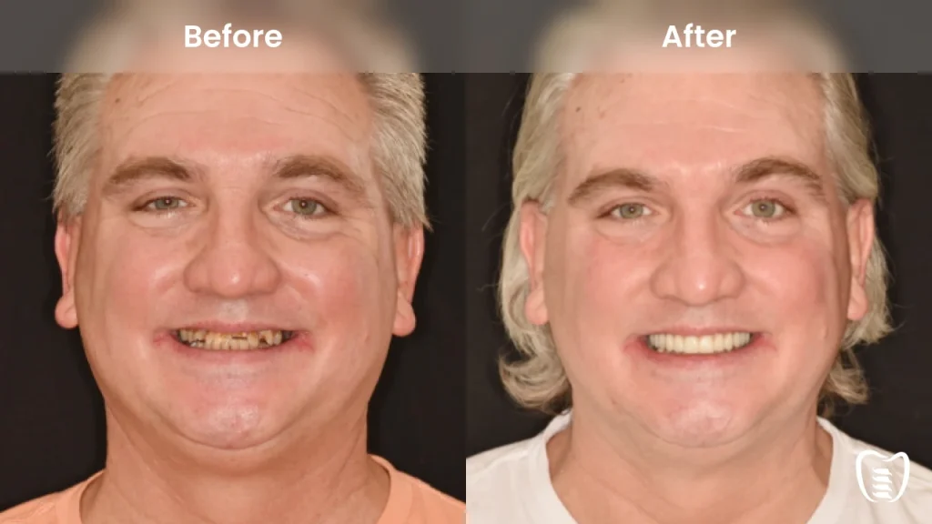 Before and after dental implants at All On Implants Charleston