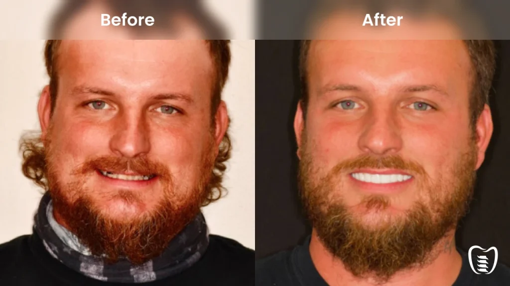 Before and after dental implants at All On Implants Charleston