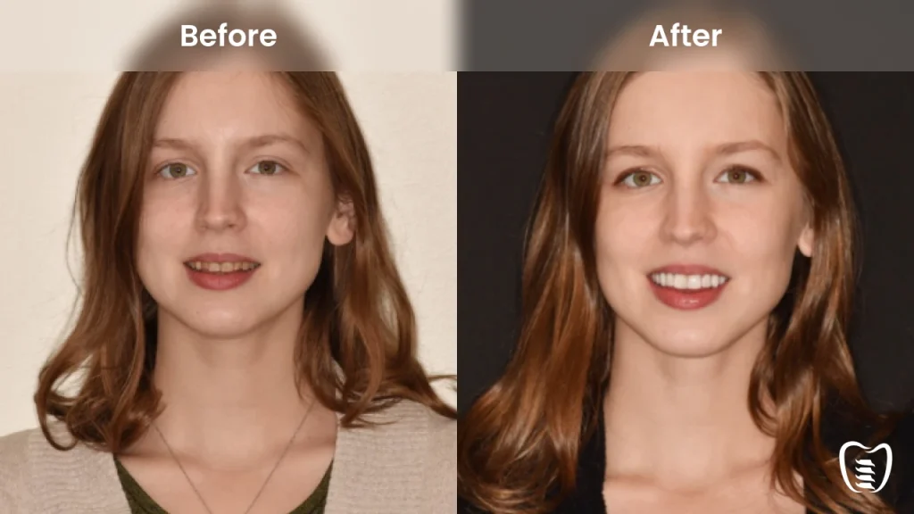 Before and after dental implants at All On Implants Charleston