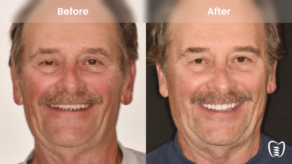 Before and after dental implants at All On Implants Charleston