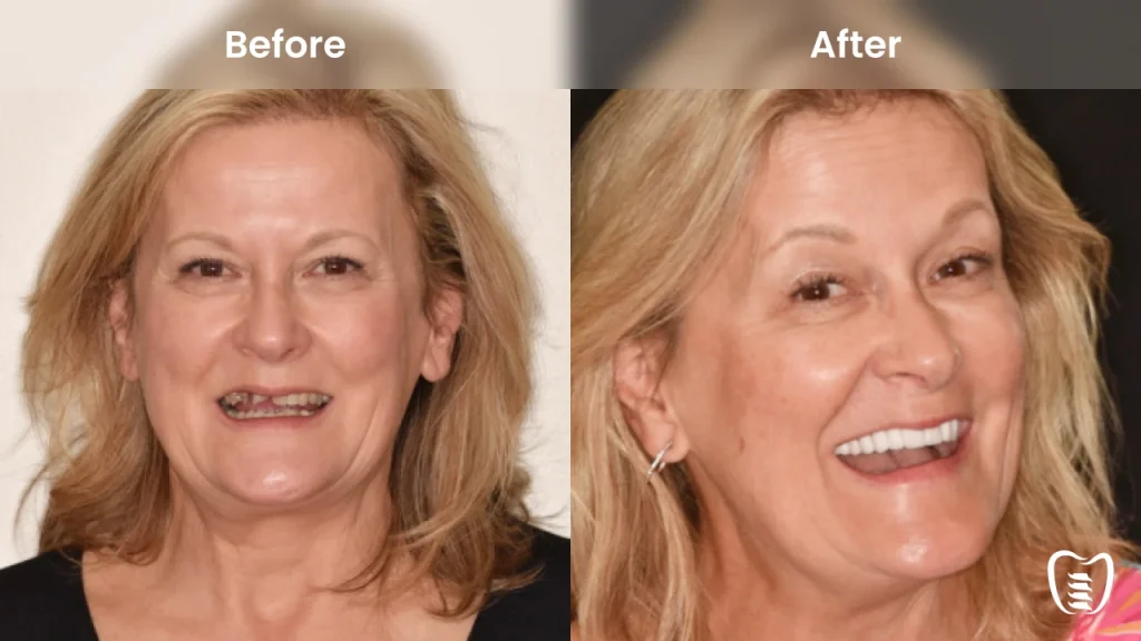 Before and after dental implants at All On Implants Charleston