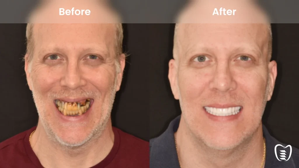 Before and after dental implants at All On Implants Charleston