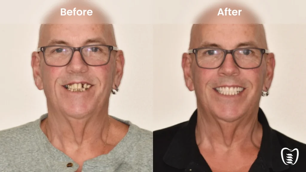 Before and after dental implants at All On Implants Charleston