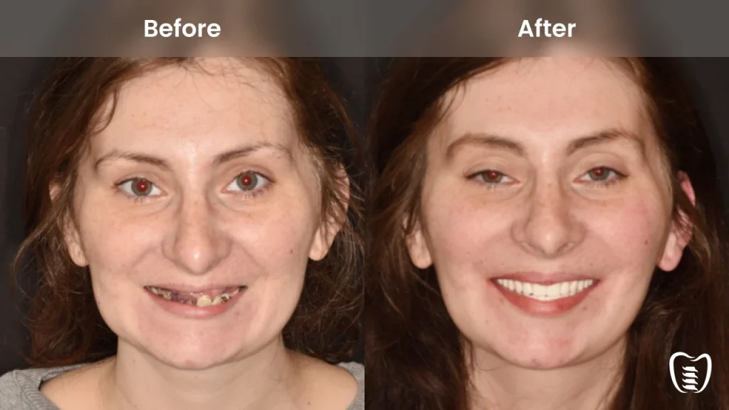 Before and after dental implants at All On Implants Charleston